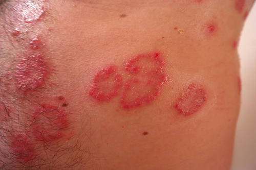  foods to avoid with psoriasis: Image of psoriasis rash flare-up.