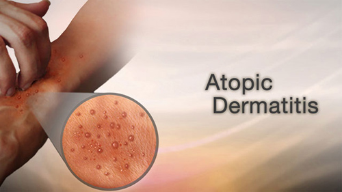 how to treat dermatitis