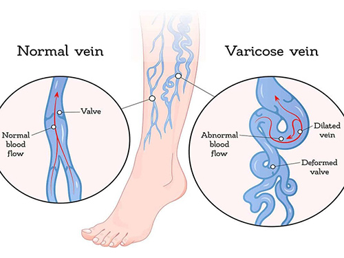 illustration showing a normal vein and varicose veins
