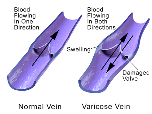 Do varicose veins hurt