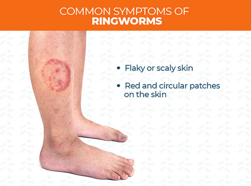 how to cure ringworm fast