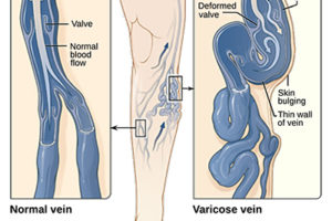 What are Varicose Veins? 1