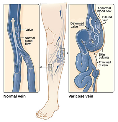 what are varicose veins