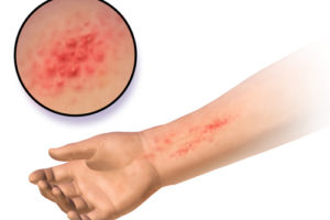 How To Treat Dermatitis 3