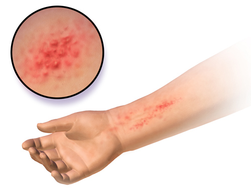 How to treat contact dermatitis