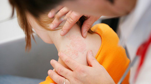 How To Treat Dermatitis 1