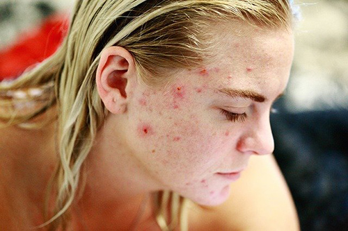 woman with a bad case of acne