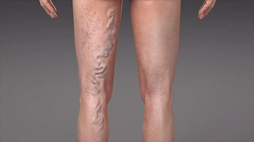 varicose veins in one of two legs