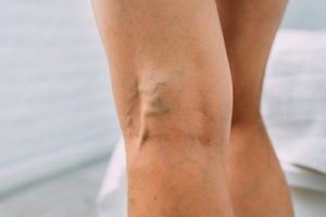 Herbs for Varicose Veins 5