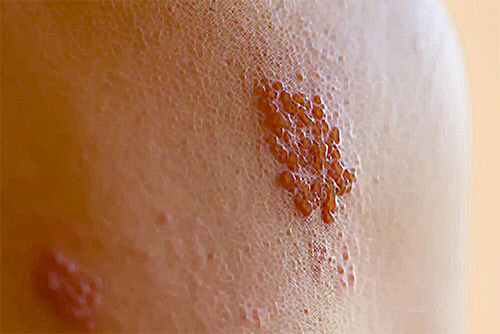 shingles rash on the skin
