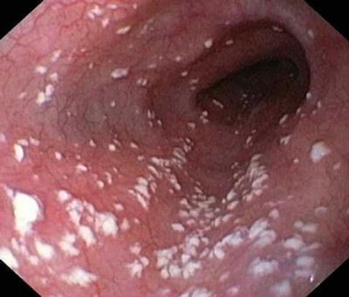 candida overgrowth on the lining of the stomach