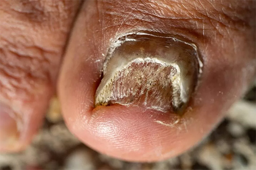 toenail badly infected with candida