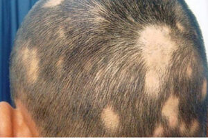 someone head with alopecia