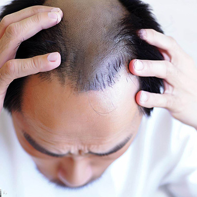 natural remedies for alopecia