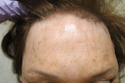 man's forehead showing the hair loss associated with alopecia