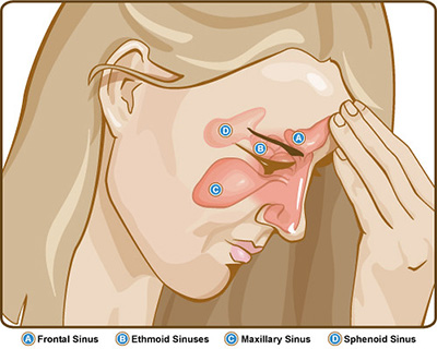 woman holding hand to her head because of a sinus headache