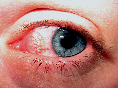 natural remedies for red eyes