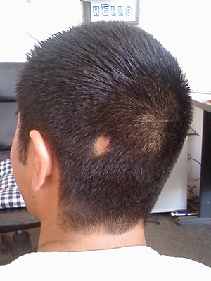 man showing the begining symptoms of patching associated with alopecia