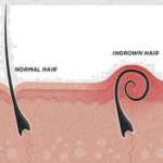 ingrown hair image explanation