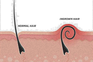 ingrown hair image explanation