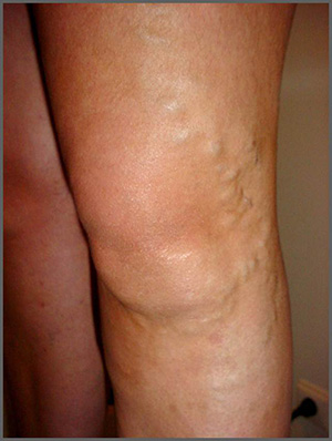 Discover The Best Natural Remedies for Varicose Veins 2