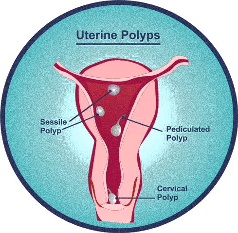 natural remedies for cervical polyps