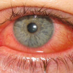eye of someone suffering from conjunctivitis