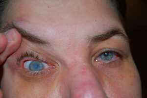 woman suffering from corneal ulcer