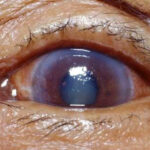 eye of someone suffering from glaucoma