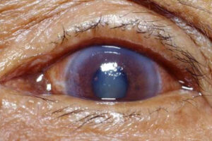 eye of someone suffering from glaucoma