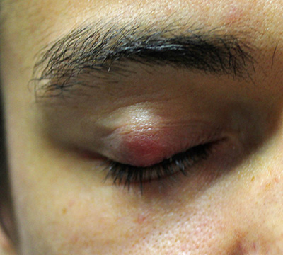 someone suffering from a chalazion eye condition