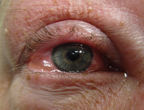 natural remedies for conjunctivitis