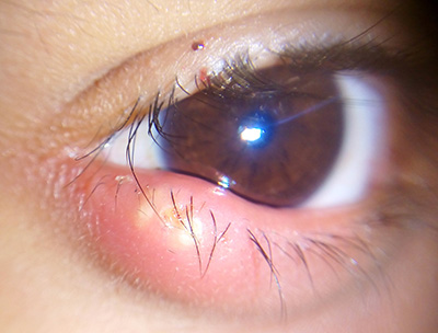 Hordeolum and Chalazion