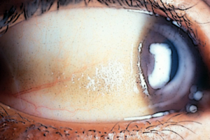 person's eye with bitot's spots