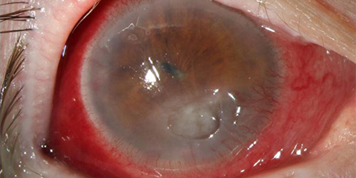 corneal ulcers