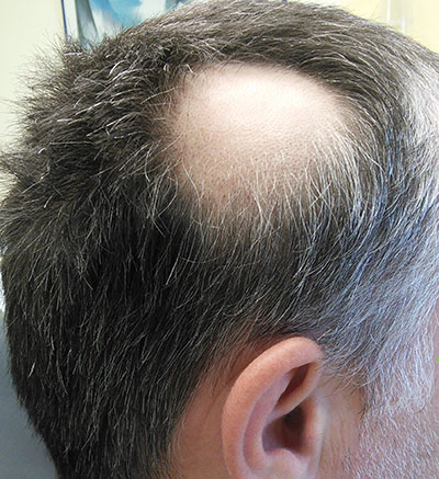 someones with a patch of hair missing due to alopecia