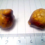 two different sizes of gallstones