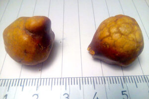 two different sizes of gallstones