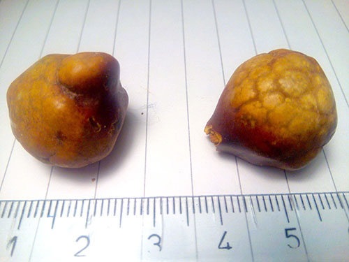 Gallstones Size Chart: Know The Facts, Protect Your Gallbladder