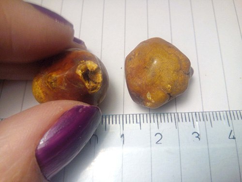 Gallstones Size Chart: Know The Facts, Protect Your Gallbladder