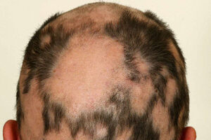 man's patchy head due to alopecia