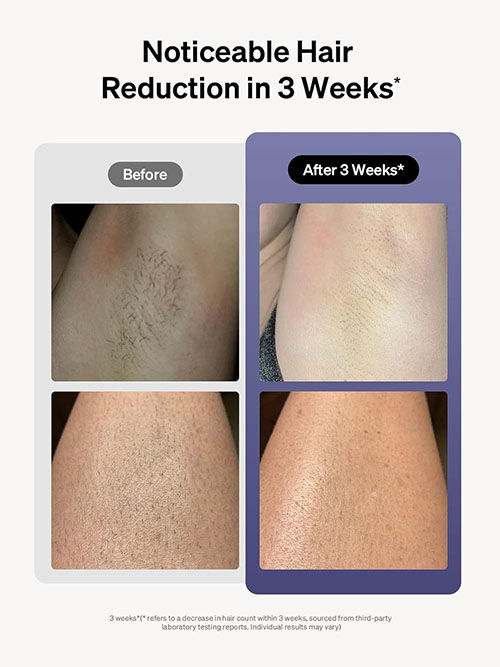 Ulike Laser Hair Removal for Women and Men
