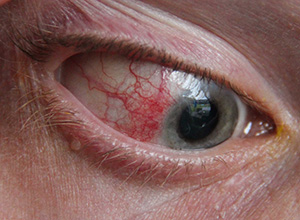 someones eye with Episcleritis