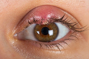 blepharitis in someones eye