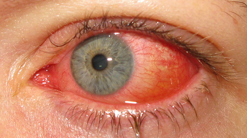 What Is Commonly Misdiagnosed as Pink Eye