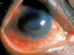 an eye suffering from uveitis