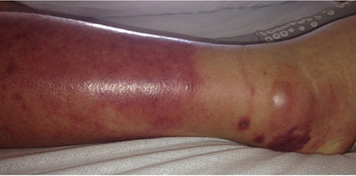 A swollen leg. A symptom of getting bitten by a tick.