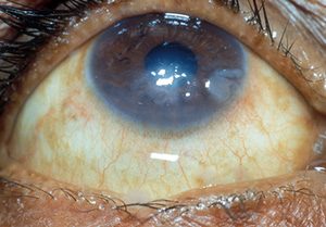 an eye that suffers from keratitis