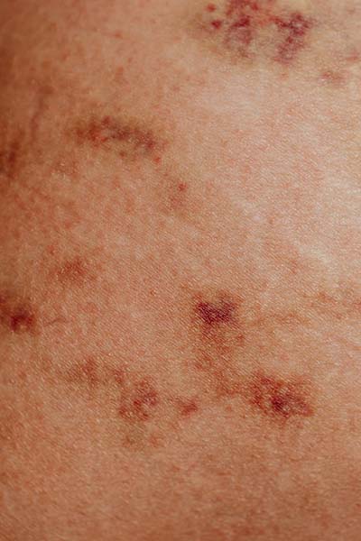 liver spots on someone's skin