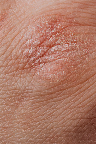 closeup look at someone's skin suffering from eczema